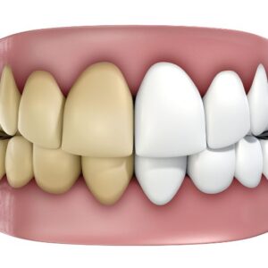 Yellow teeth - what can you do about it?